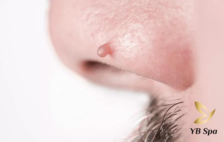 Mụn thịt ở mũi là gì? Nguyên nhân và cách điều trị hiệu quả 18 Mụn thịt ở mũi là là các khối u nhỏ lành tính xuất hiện trên da