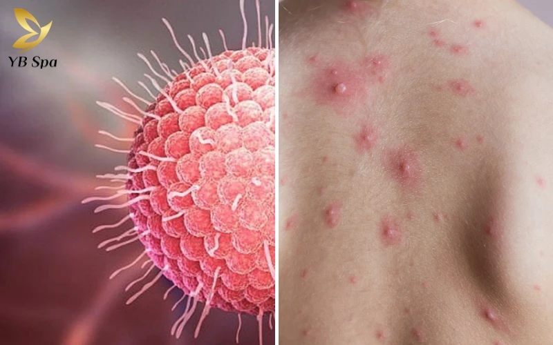 Thủy đậu là gì?