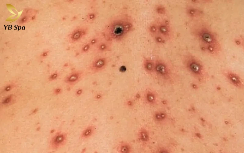 Giai đoạn khô miệng mụn và đóng vảy: ngày thứ 6–10