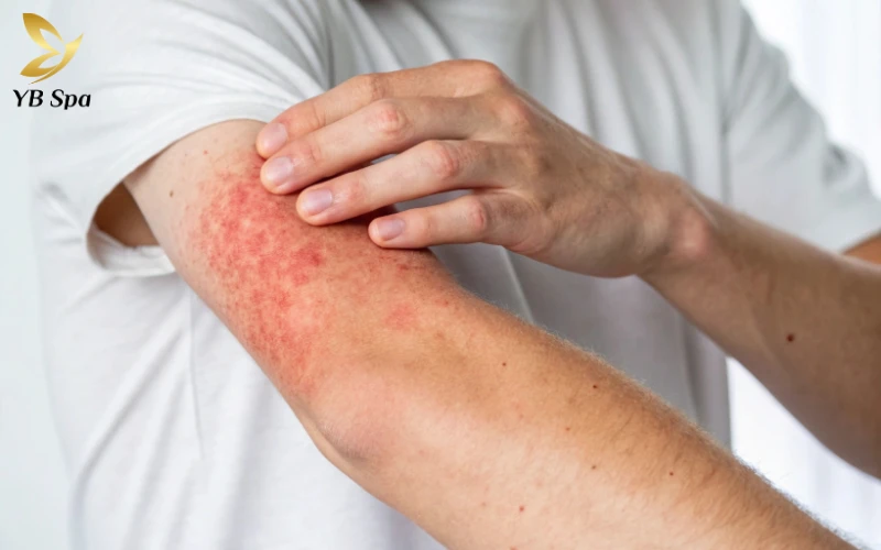 Kiểm soát cơn ngứa và thói quen gãi