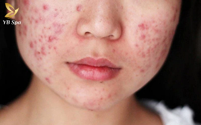 Mụn Trứng Cá Có Tự Hết Không?