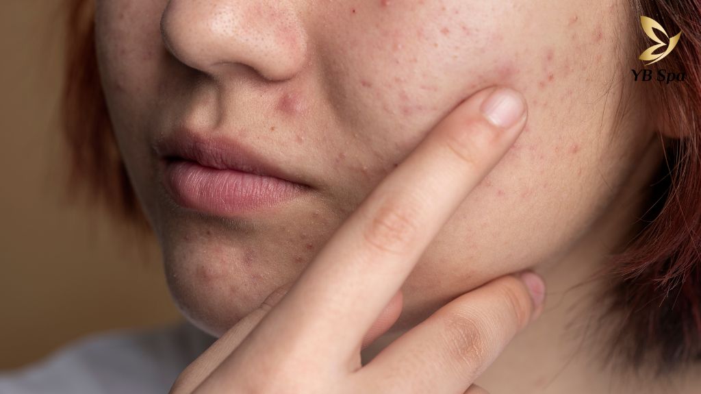 Mun Trung Ca Tuoi Day Thi 2