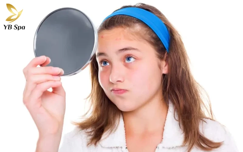 Mụn Tuổi Dậy Thì Có Tự Hết Không?