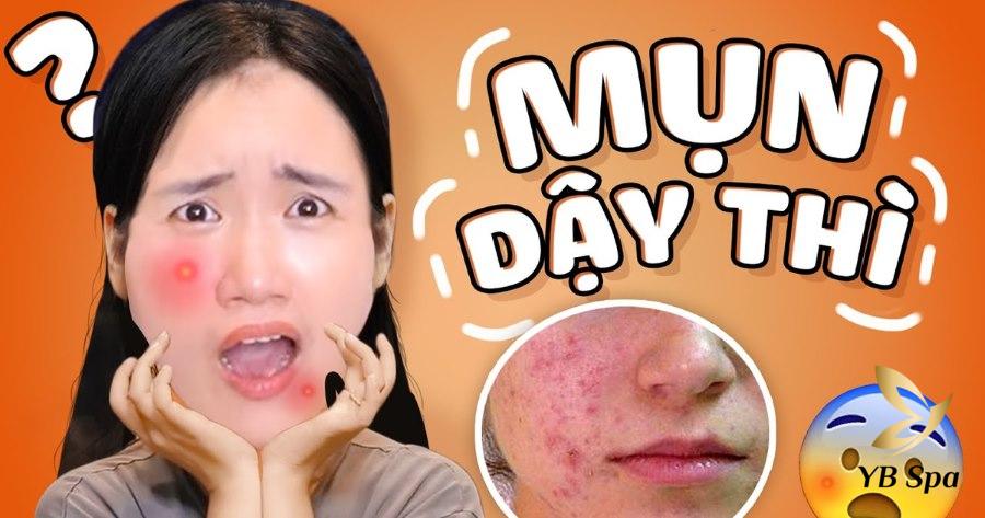 mụn tuổi dậy thì kéo dài bao lâu