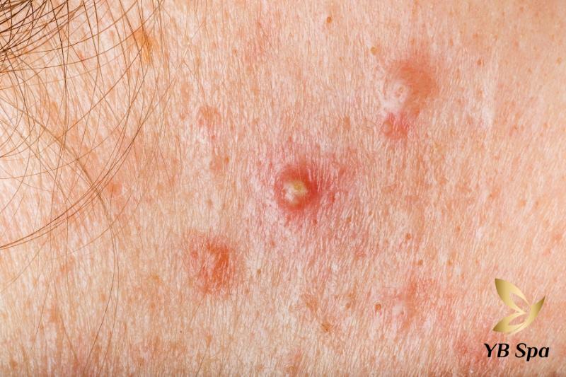 Mụn viêm có nên nặn không? Khi nào nên nặn mụn viêm? 20 Mụn mủ trên da