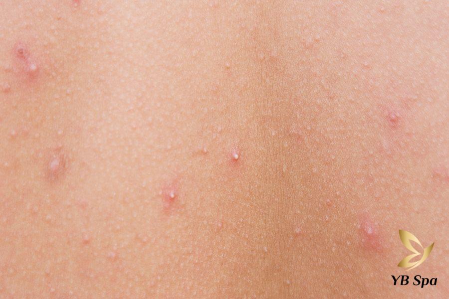 Mụn viêm có nên nặn không? Khi nào nên nặn mụn viêm? 22 Mụn viêm đầu trắng