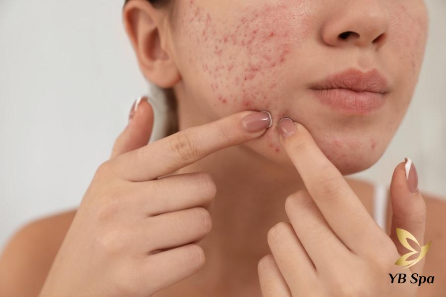 Mụn viêm có nên nặn không? Khi nào nên nặn mụn viêm? 23 Nặng mụn bằng tay