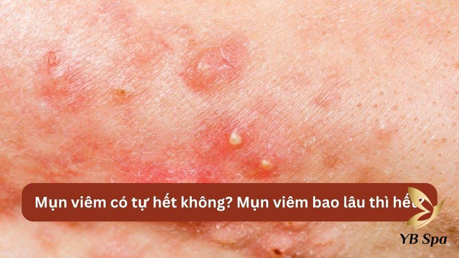 Mụn viêm có tự hết không? Mụn viêm bao lâu thì hết?