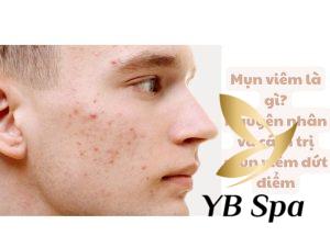 Mụn viêm là gì? Nguyên nhân và cách trị mụn viêm dứt điểm