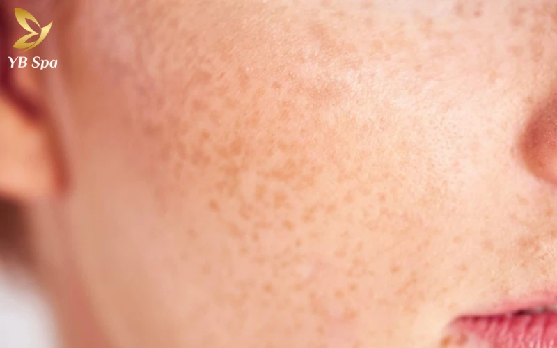 Nám chân sâu là gì