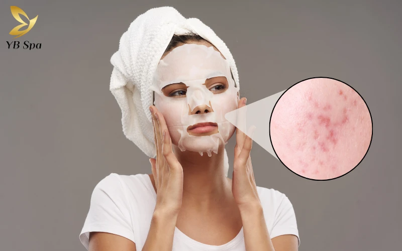 Nặn mụn xong có nên đắp mặt nạ không