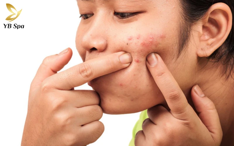 Nặn Mụn Xong Nên Làm Gì Để Không Bị Thâm?