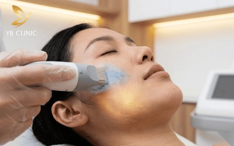 Đầu tip Thermage FLX 4.0 giúp thắt chặt mạng lưới collagen và bảo vệ bề mặt da.