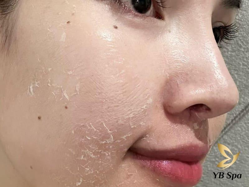 Nên lăn kim hay Peel da? Cái nào tốt hơn? Lưu ý cần biết 19 Peel da giúp loại bỏ lớp tế bào sừng cũ, bụi bẩn trên bề mặt da ở các mức độ nông sâu khác nhau.
