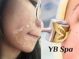 Nên lăn kim hay Peel da? Cái nào tốt hơn? Lưu ý cần biết