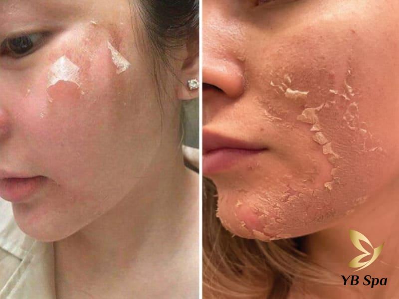 Nên lăn kim hay Peel da? Cái nào tốt hơn? Lưu ý cần biết 21 Peel da là hình thức làm đẹp có độ an toàn và ứng dụng cao, được bộ y tế cho phép thực hiện tại các cơ sở y khoa