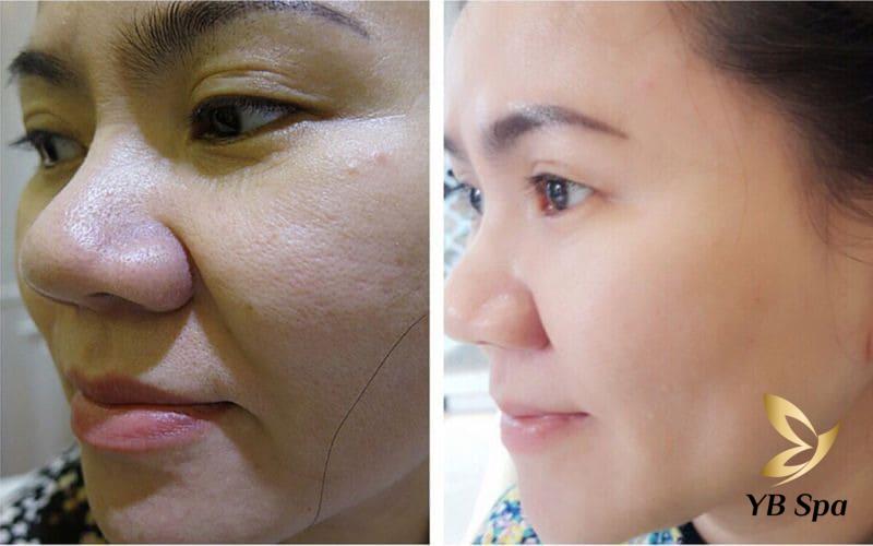 Nên lăn kim hay Peel da? Cái nào tốt hơn? Lưu ý cần biết 22 Những lưu ý cần biết trước và sau khi lăn kim