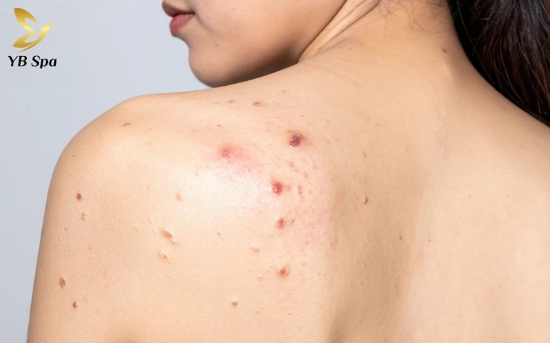 mụn lưng ở nữ giới