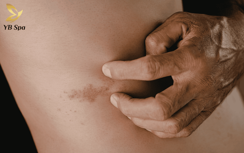 Da chân nổi mẩn sau triệt lông: Hiểu đúng 5 nguyên nhân để có quy trình phục hồi chuẩn y khoa