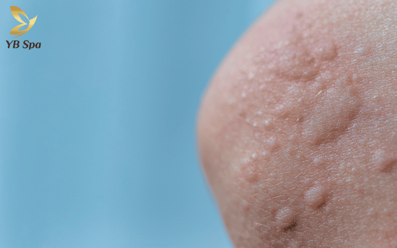 Histamine – "thủ phạm" gây ra tình trạng sưng đỏ tạm thời do tác động nhiệt trong quá trình triệt lông