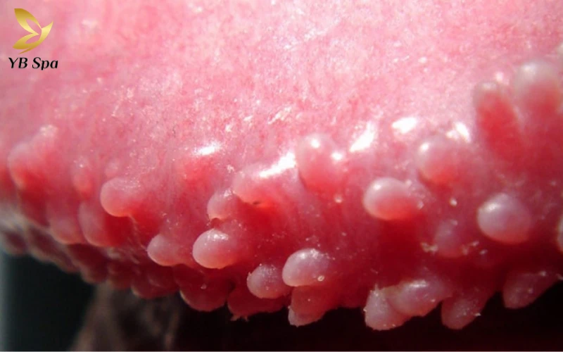 Nổi mụn nhỏ trắng ở rãnh bao quy đầu