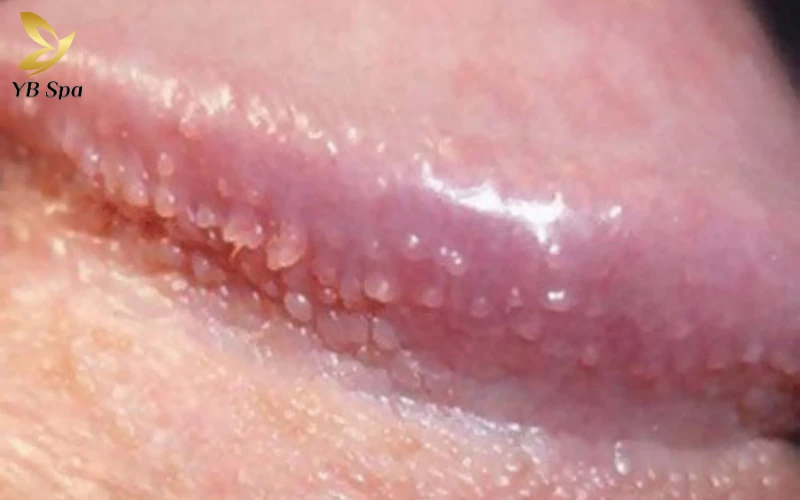 Nổi mụn nhỏ trắng ở rãnh bao quy đầu là gì?