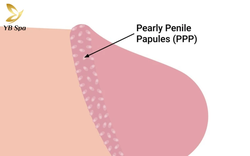 Chuỗi hạt ngọc dương vật (Pearly Penile Papules)