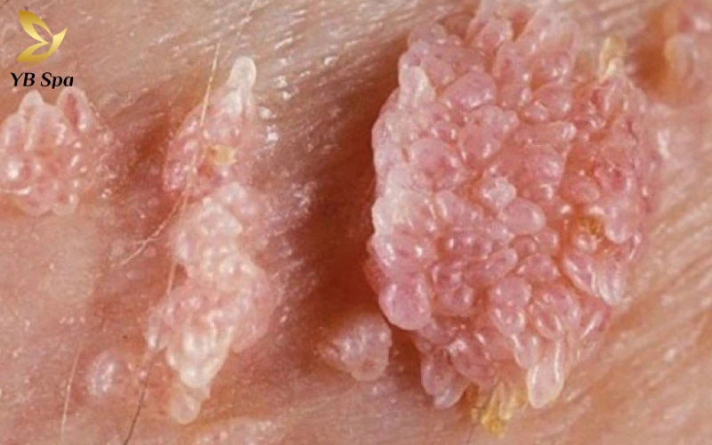 Bệnh lây truyền qua đường tình dục (STDs)