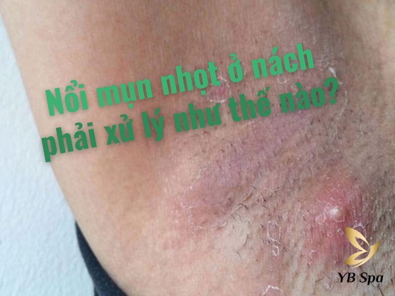 nổi mụn nhọt ở nách