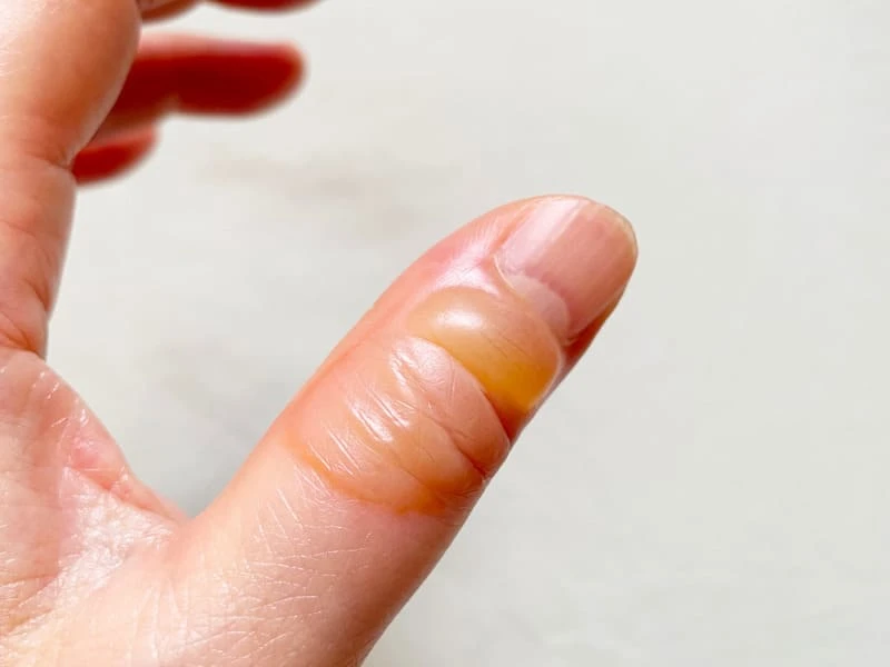 Tình trạng nổi mụn nước không ngứa là dấu hiệu của bệnh gì? 18 Mụn nước trên ngón tay