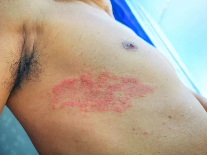 Tình trạng nổi mụn nước không ngứa là dấu hiệu của bệnh gì? 19 Mụn nước trên da