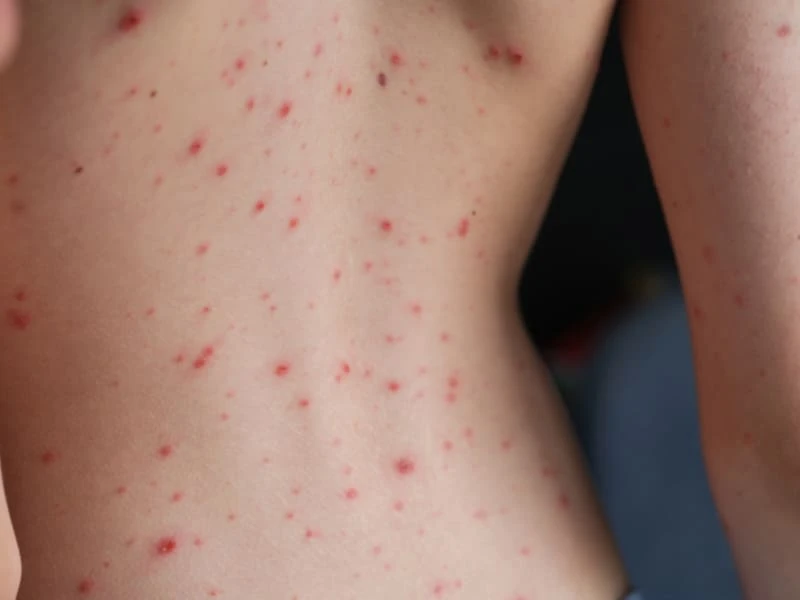 Tình trạng nổi mụn nước không ngứa là dấu hiệu của bệnh gì? 28 Tình trạng nổi mụn nước không ngứa là dấu hiệu của bệnh gì?