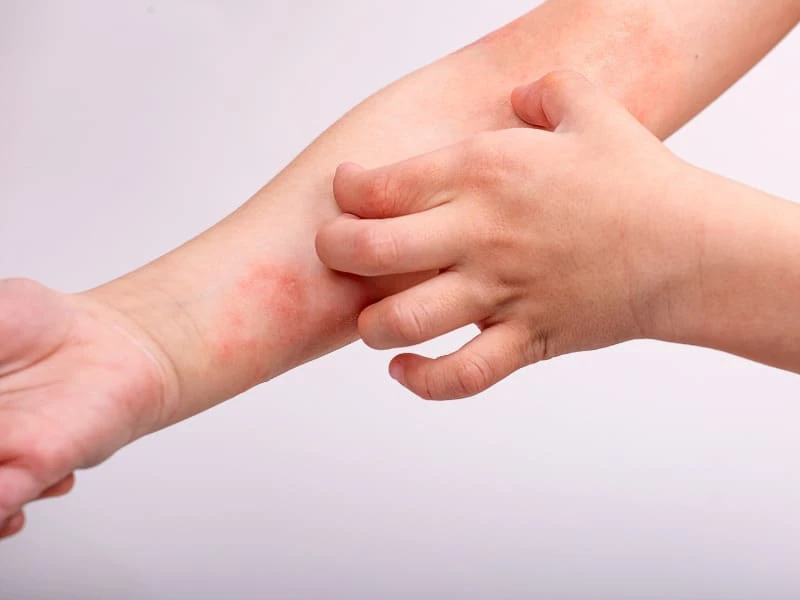 Nổi mụn nước là bệnh gì? Nguyên nhân và cách xử lý an toàn 12 Mụn nước ở tay gây ngứa