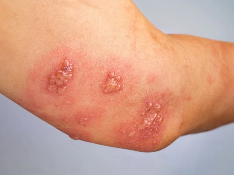 Nổi mụn nước là bệnh gì? Nguyên nhân và cách xử lý an toàn 13 Mụn nước sau bắp tay