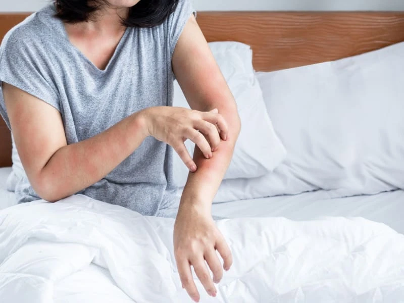 Nổi mụn nước là bệnh gì? Nguyên nhân và cách xử lý an toàn 14 Mụn nước nổi trên cánh tay
