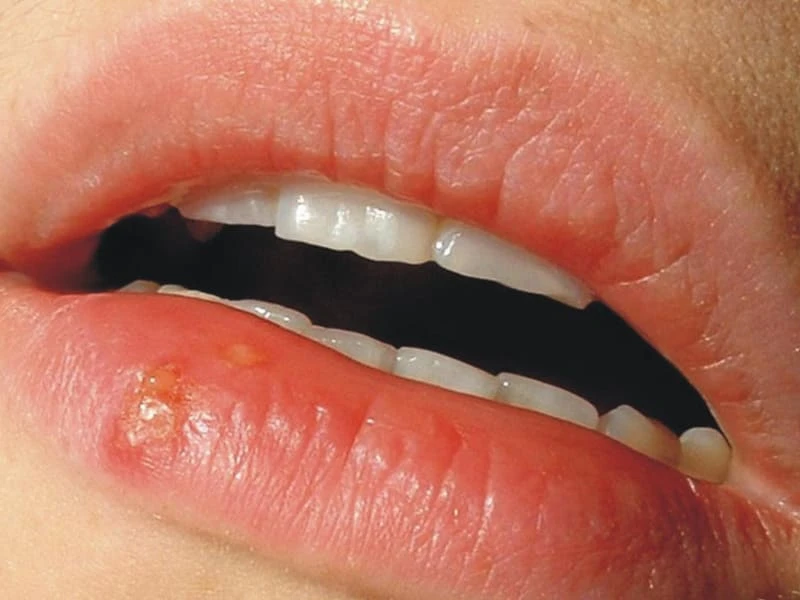 Nổi mụn nước trong miệng là bệnh gì? Cách chữa an toàn 18 Mụn nước nổi trê môi