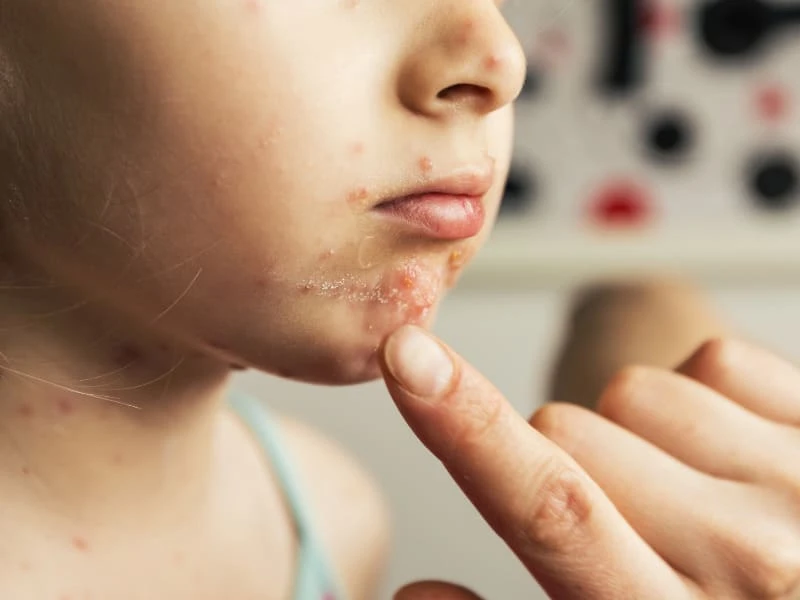 Nổi mụn nước trong miệng là bệnh gì? Cách chữa an toàn 19 Trẻ em bị nổi mụn nước