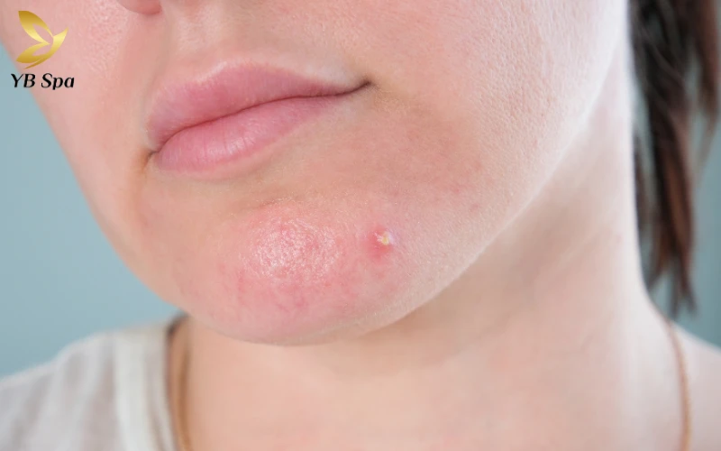 Nổi mụn ở cằm là thiếu chất gì? Giải mã nguyên nhân từ bên trong cơ thể 26 Nổi mụn ở cằm là thiếu chất gì