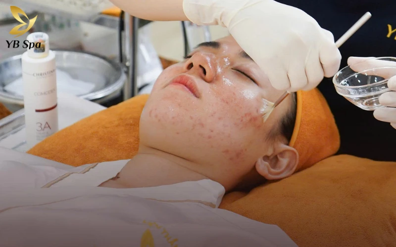 Nổi mụn ở cằm là thiếu chất gì? Giải mã nguyên nhân từ bên trong cơ thể 38 Trải nghiệm liệu trình chăm sóc mụn chuyên nghiệp tại YB Spa