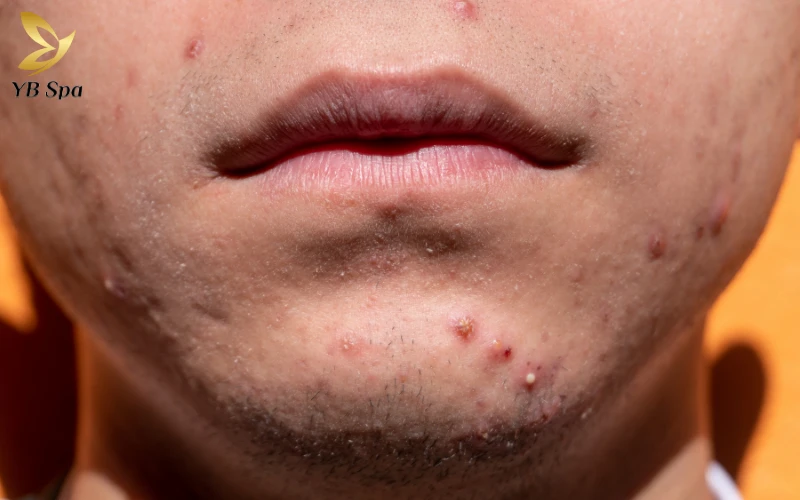 Nổi mụn ở cằm là thiếu chất gì? Giải mã nguyên nhân từ bên trong cơ thể 27 Tác động của thiếu hụt dinh dưỡng đối với da vùng cằm