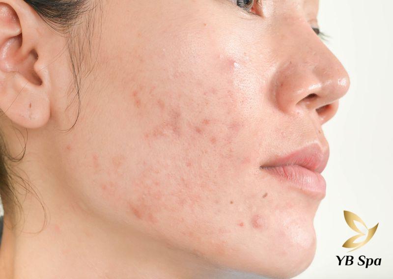 nổi mụn ở má phải