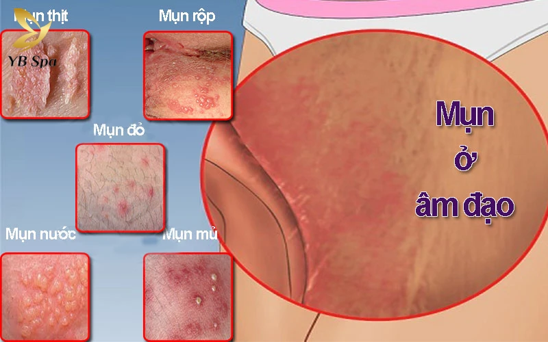 Nổi mụn ở môi bé vùng kín là gì? Những điều nữ giới cần hiểu đúng để bảo vệ sức khỏe 23 Nổi mụn ở môi bé vùng kín là gì? Những điều nữ giới cần hiểu đúng để bảo vệ sức khỏe