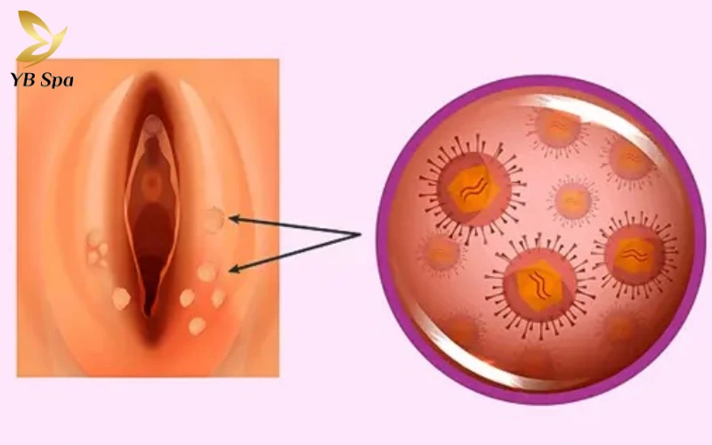 Nổi mụn ở môi lớn vùng kín là gì?