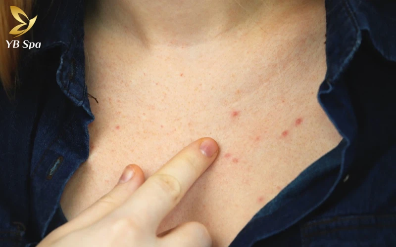 Nổi mụn ở ngực