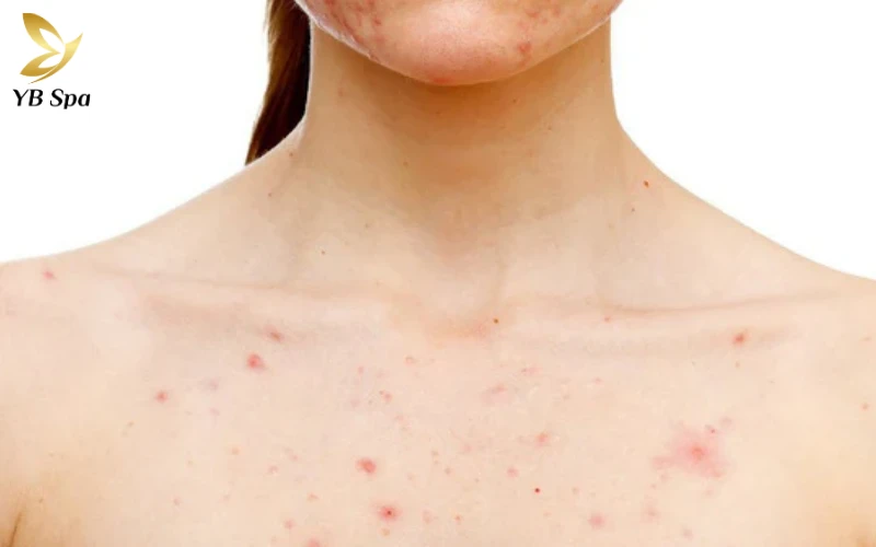 Nổi mụn ở ngực có nguy hiểm không? Nguyên nhân và hướng xử lý 23 Nổi mụn ở ngực có nguy hiểm không? Nguyên nhân và hướng xử lý