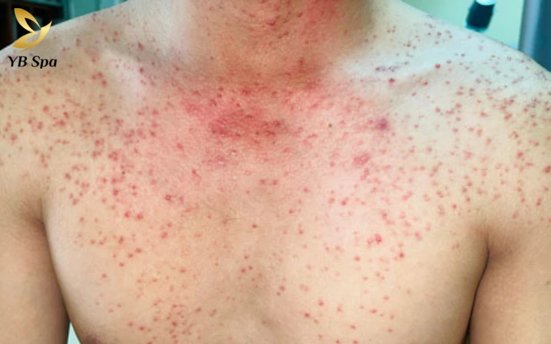 Nổi mụn ở ngực có nguy hiểm không? Nguyên nhân và hướng xử lý 25 Viêm nang lông ở ngực