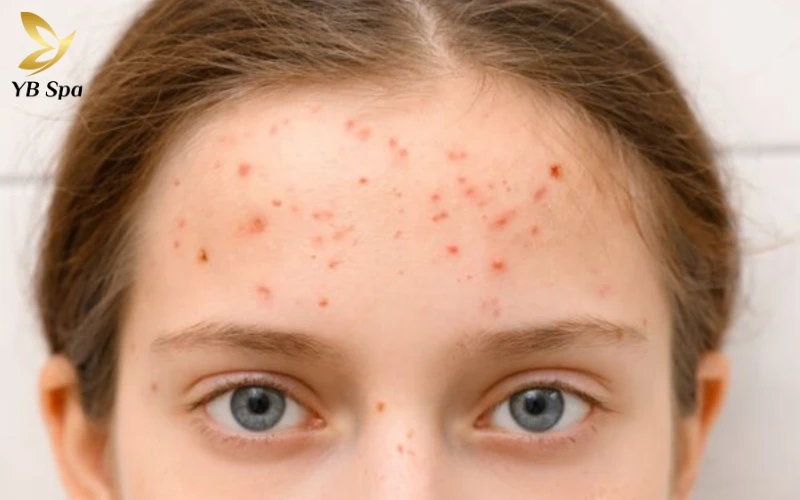 Nổi Mụn Ở Trán Thiếu Chất Gì?