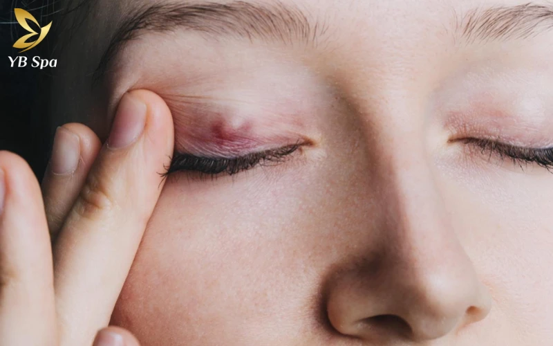 Nổi Mụn Ở Trong Mí Mắt Trên: Nguyên Nhân Và Cách Điều Trị Hiệu Quả