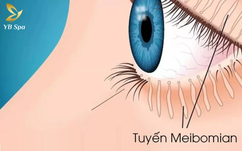Tắc Nghẽn Tuyến Dầu (Tuyến Meibomian)