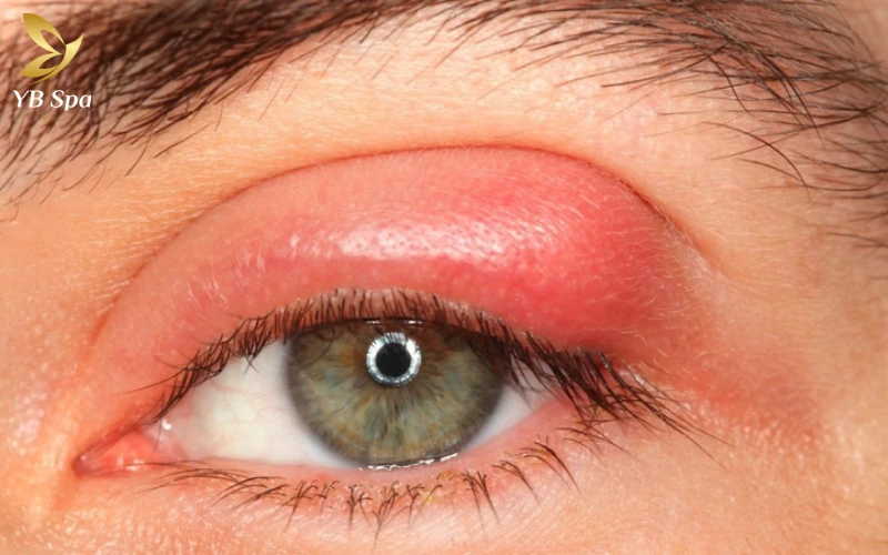 Dấu Hiệu Nhận Biết Mụn Trong Mí Mắt Trên